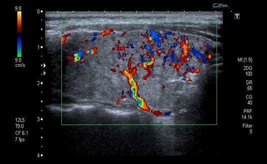 INTRAVASCULAR FLOW IN THYROID GLAND