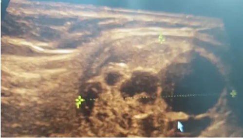 Colloid cyst 2