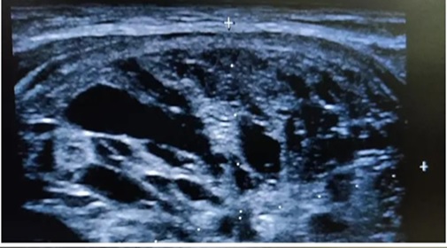 Colloid cyst