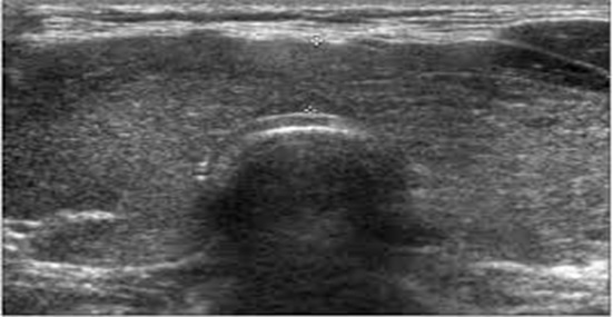 DIFFUSE ENLARGEMENT OF THE THYROID