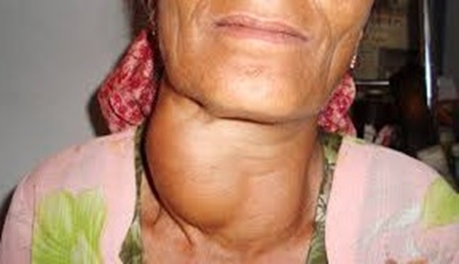 GOITER PATIENT