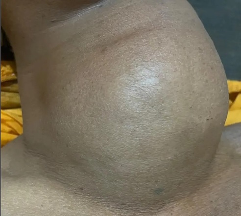 GOITER