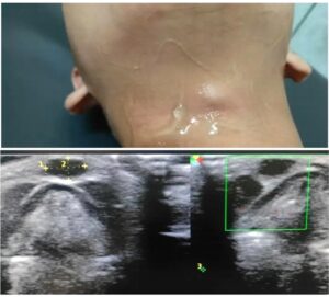CASE 1. HISTORY: 3 years old girl child presented with midline neck swelling 