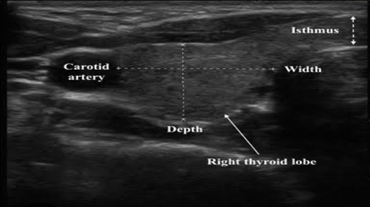 How to Measure The Thyroid Lobes