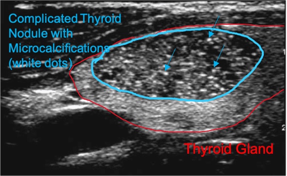 MICROCALCIFICATION IN THYROID GLAND