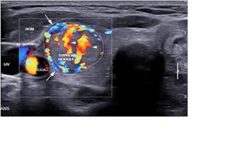 REGIONAL FLOW IN THYROID GLAND