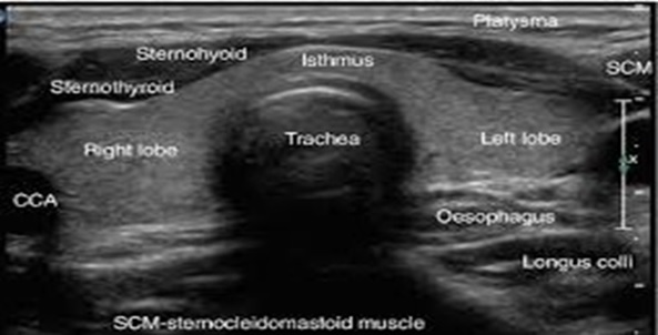 SONOGRAPHIC LANDMARK