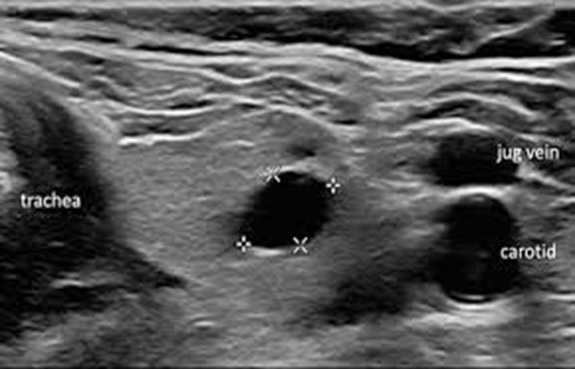THYROID CYST