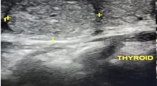 THYROID NODULE