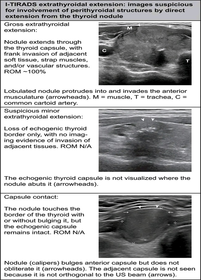 THYROID SONOGRAPHIC FEATURES 5