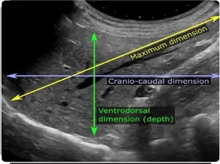 How to Measure the Liver Dimensions