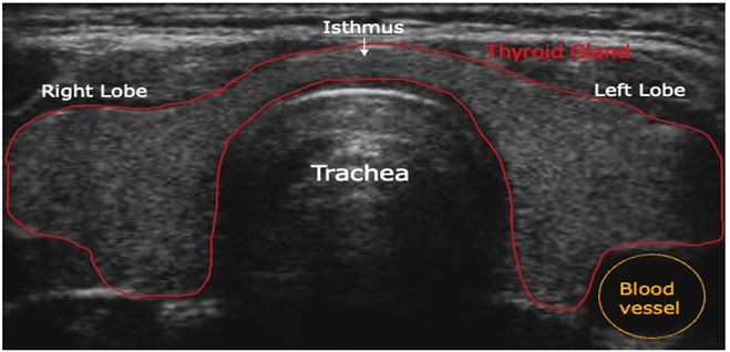 sonographic view of a normal thyroid